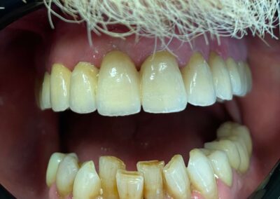 Denti allineati e disallineati