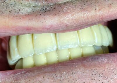 Occlusione denti allineati